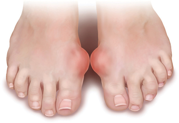 Bệnh gout có chữa khỏi được không?