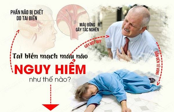 Phòng ngừa tai biến mạch máu não hiệu quả