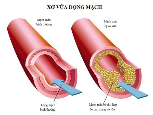 Nguyên nhân và dấu hiệu nhận biết xơ vữa động mạch