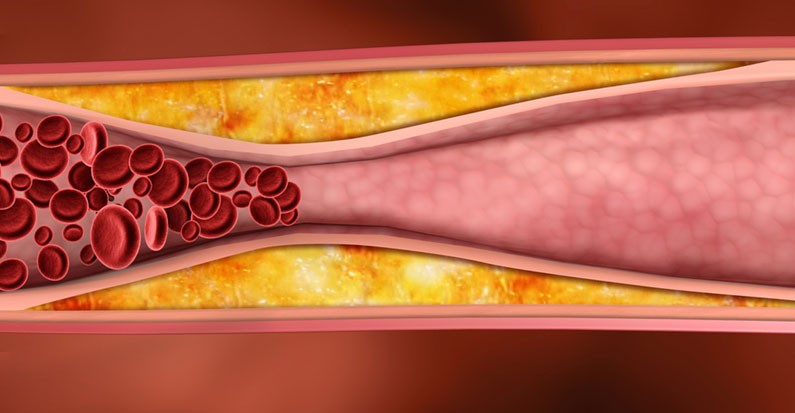 Nguyên nhân và Cách điều trị Xơ vữa động mạch