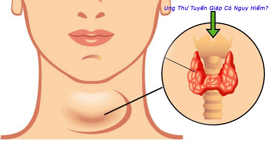 Ung thư tuyến giáp có nguy hiểm?