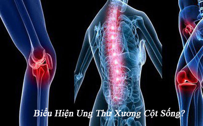 Biểu hiện của bệnh ung thư xương cột sống