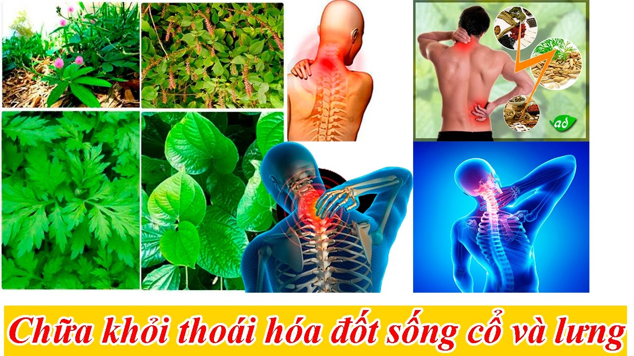 Cách chữa thoái hóa cột sống hiệu quả