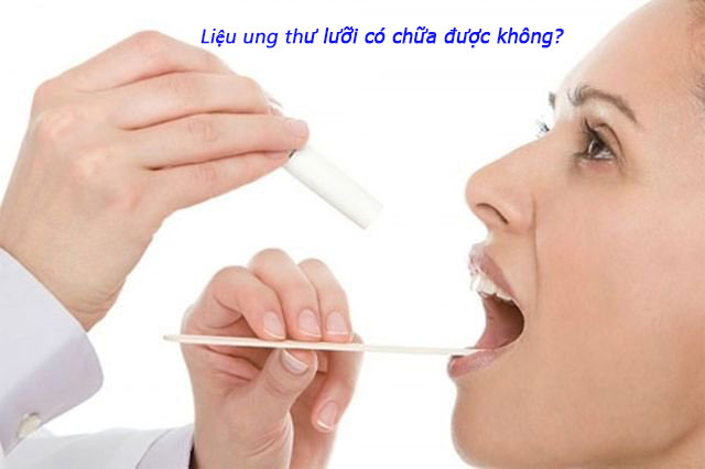 Liệu có thể chữa bệnh Ung thư lưỡi?