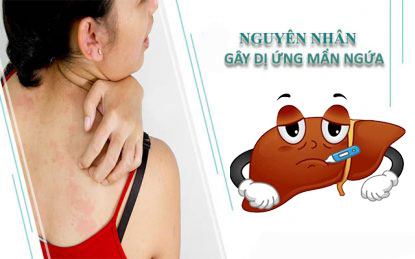 Suy giảm chức năng gan – Nguyên nhân gây mẩn ngứa