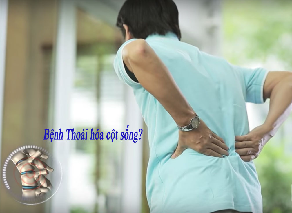 Bệnh Thoái hóa cột sống là gì?