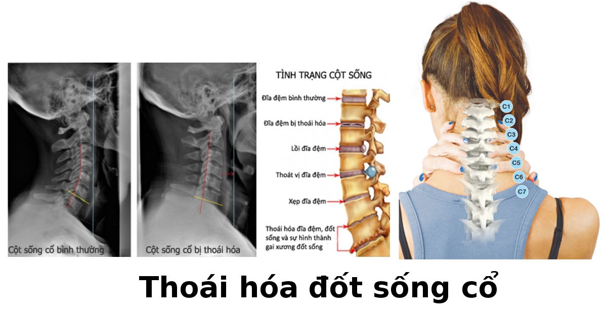 Thoái hóa đốt sống cổ là gì?