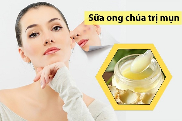 Cách trị mụn bằng sữa ong chúa hiệu quả?