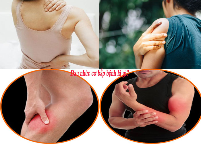 Biểu hiện của bệnh đau nhức cơ bắp