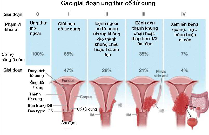 Giai đoạn của ung thư nội mạc tử cung