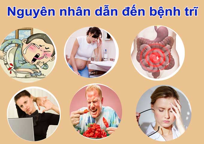 Bệnh trĩ – Nguyên nhân triệu chứng và cách điều trị