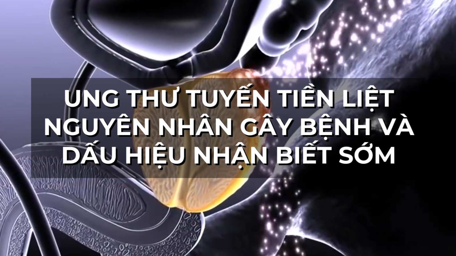 Nguyên nhân gây ra bệnh ung thư tiền liệt tuyến