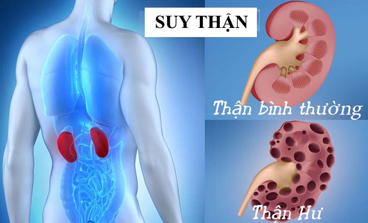 Bệnh thận mãn tính là gì?