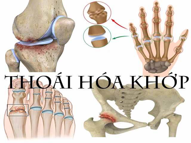 Phương pháp điều trị thoái hóa khớp?