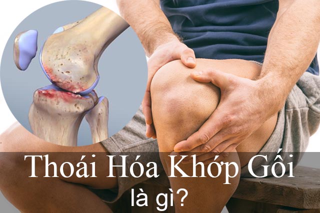 Thoái hóa khớp gối là gì?