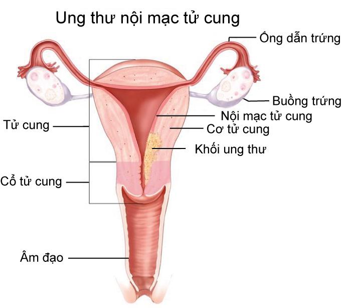 Ung thư nội mạc tử cung là gì?