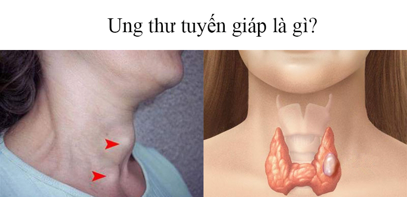 Bệnh ung thư tuyến giáp là gì?