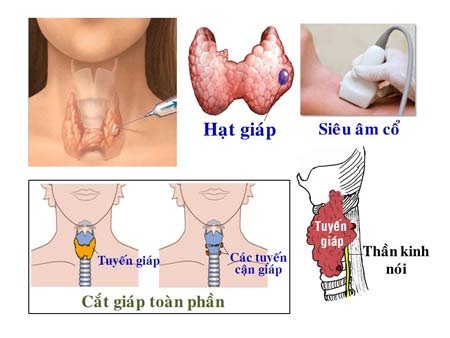 Cách điều trị ung thư tuyến giáp di căn hạch cổ?