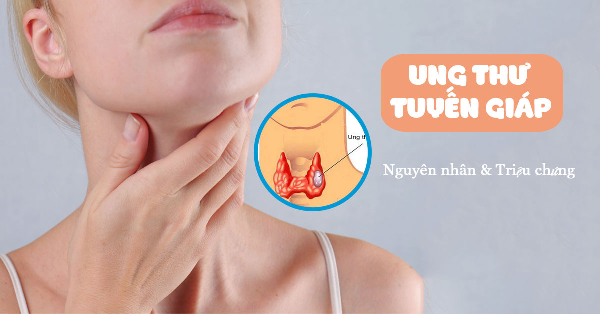 Nguyên nhân và dấu hiệu ung thư tuyến giáp?