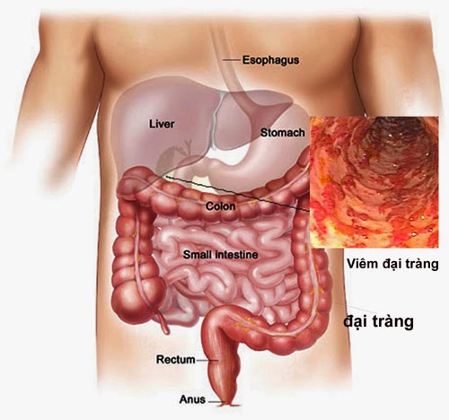 Hậu Quả Của Viêm Đại Tràng Co Thắt Và Cách Điều Trị