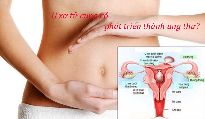 U xơ tử cung có phát triển thành ung thư?