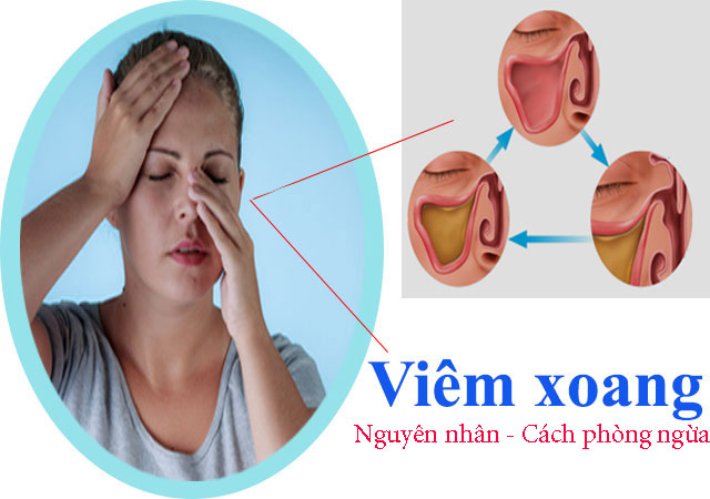 Nguyên nhân và cách phòng ngừa bệnh viêm xoang?