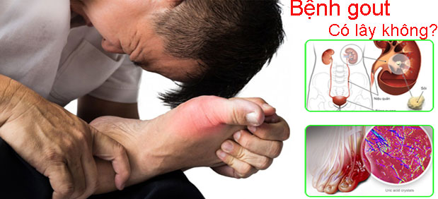 Bệnh gout có lây không? Gout nên ăn và kiêng gì?