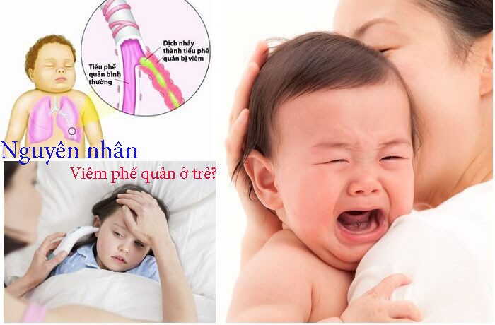 Nguyên nhân và cách điều trị bệnh viêm phế quản ở trẻ?