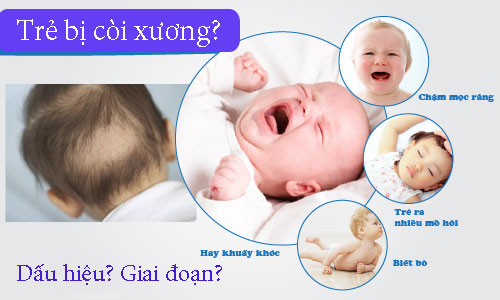 Trẻ bị còi xương có dấu hiệu và giai đoạn nào?