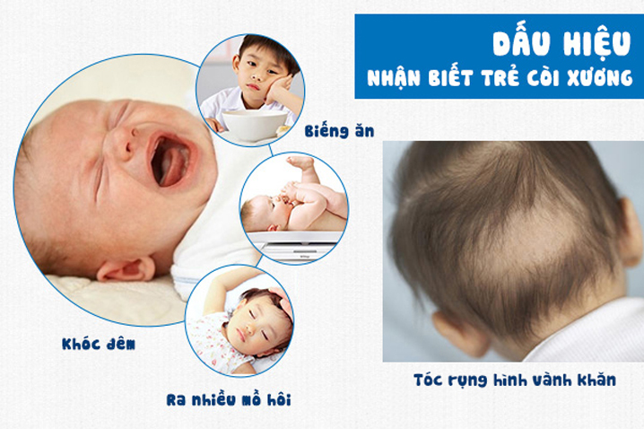 Nguyên nhân, dấu hiệu trẻ bị còi xương?