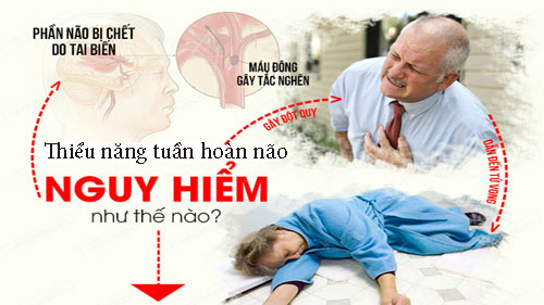 Thiểu năng tuần hoàn não sát thủ âm thầm gây đột quỵ