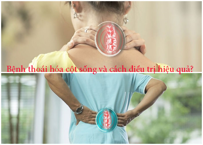 Bệnh thoái hóa cột sống và cách điều trị hiệu quả?