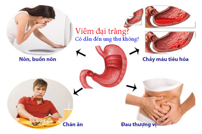 Viêm đại tràng là gì? Có dẫn đến ung thư không?