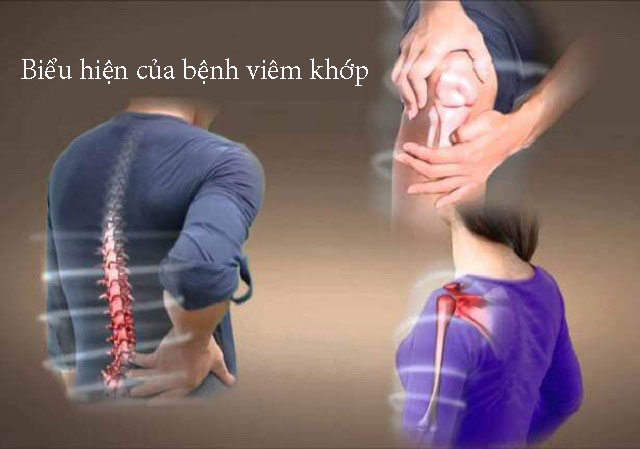 Biểu hiện của bệnh viêm khớp?