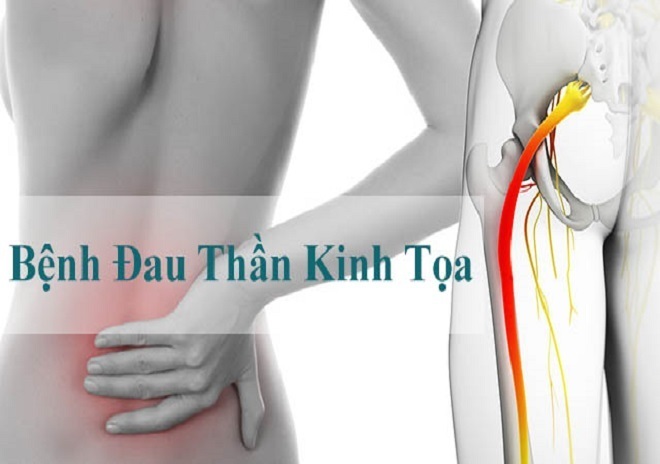 Đau thần kinh tọa có nguy hiểm?