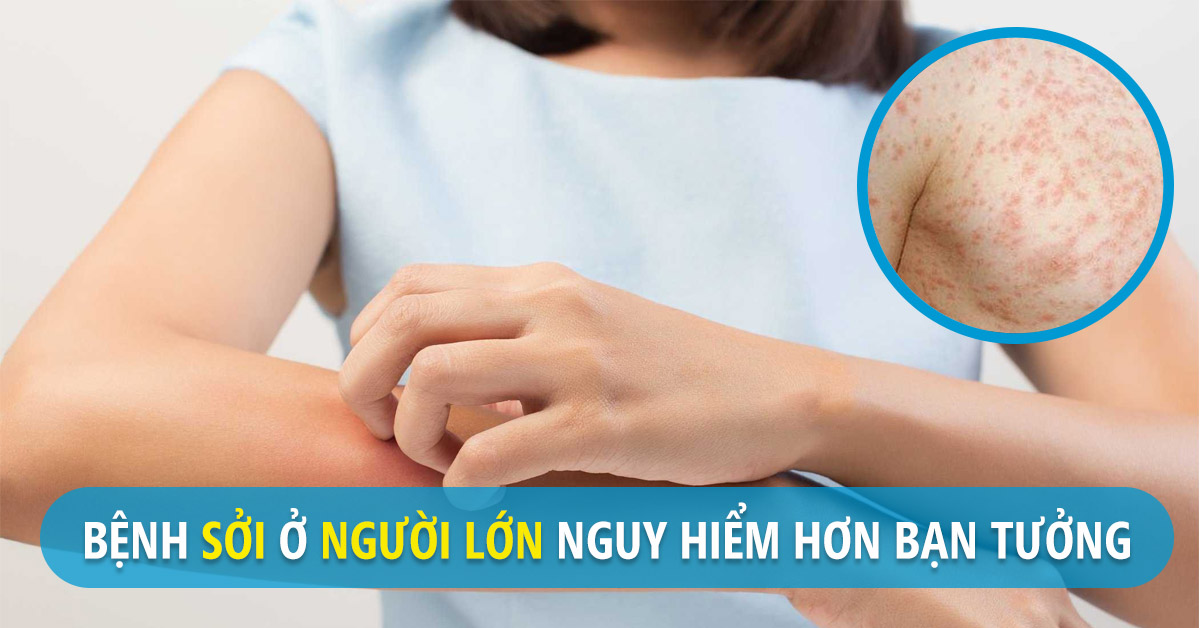 Bệnh sởi ở người lớn có nguy hiểm không?