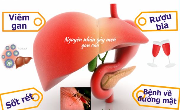 Triệu chứng, nguyên nhân và cách điều trị men gan cao