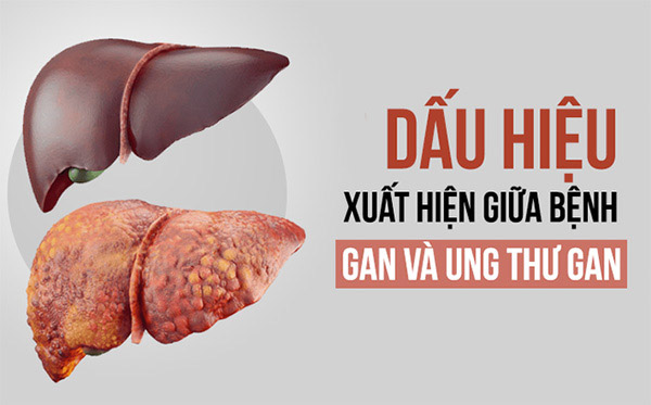 Tại sao men gan cao là dấu hiệu của bệnh xơ gan, ung thư gan?