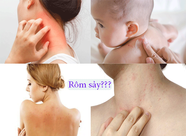 Rôm sảy là bệnh gì? Cách điều trị hiệu quả