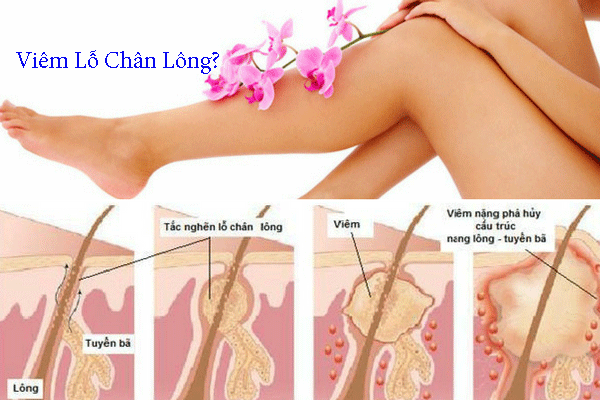 Viêm lỗ chân lông – Dấu hiệu và cách trị hiệu quả