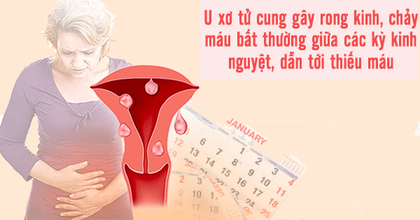 Nguyên nhân và dấu hiệu triệu chứng u xơ tử cung