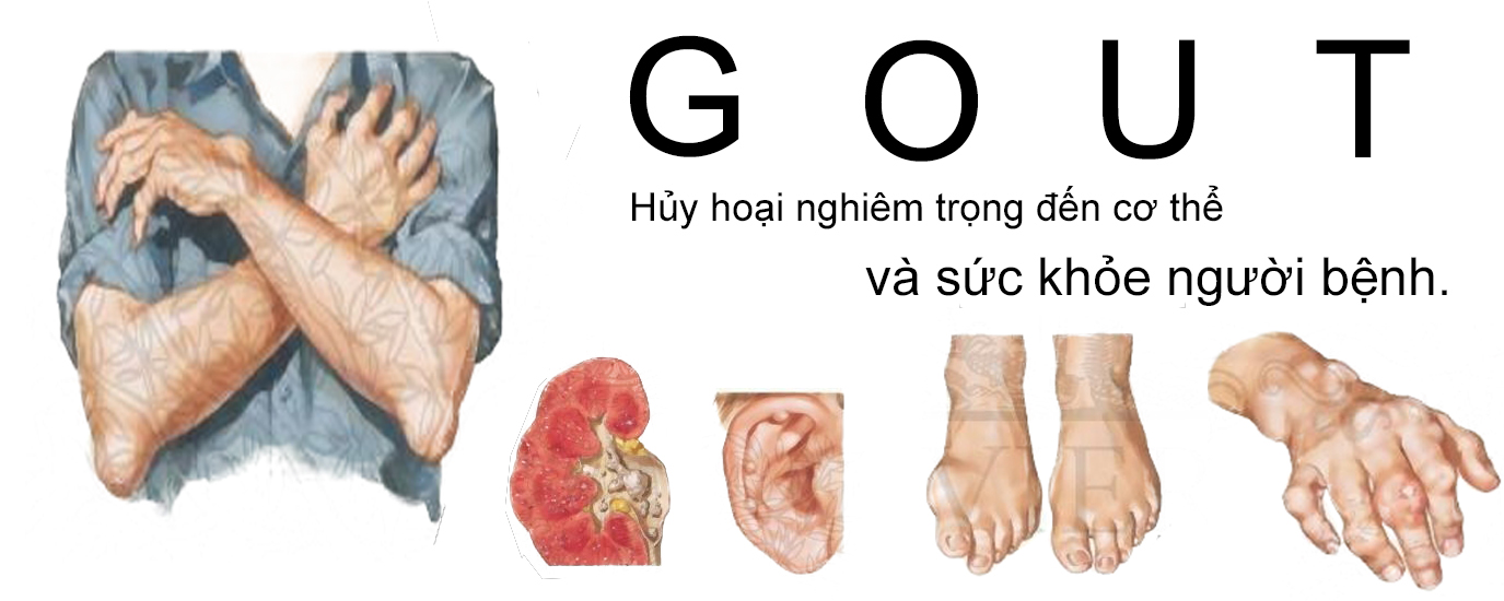 Thuốc điều trị bệnh Gout hiệu quả bất ngờ