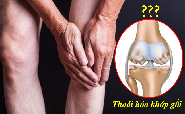 Bệnh thoái hóa khớp gối có nguy hiểm không?