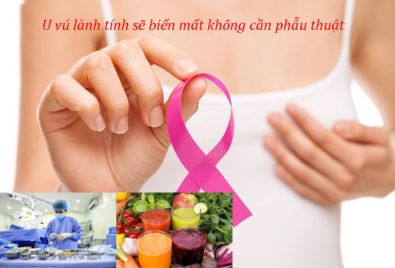 U vú lành tính sẽ biến mất mà không cần phẫu thuật