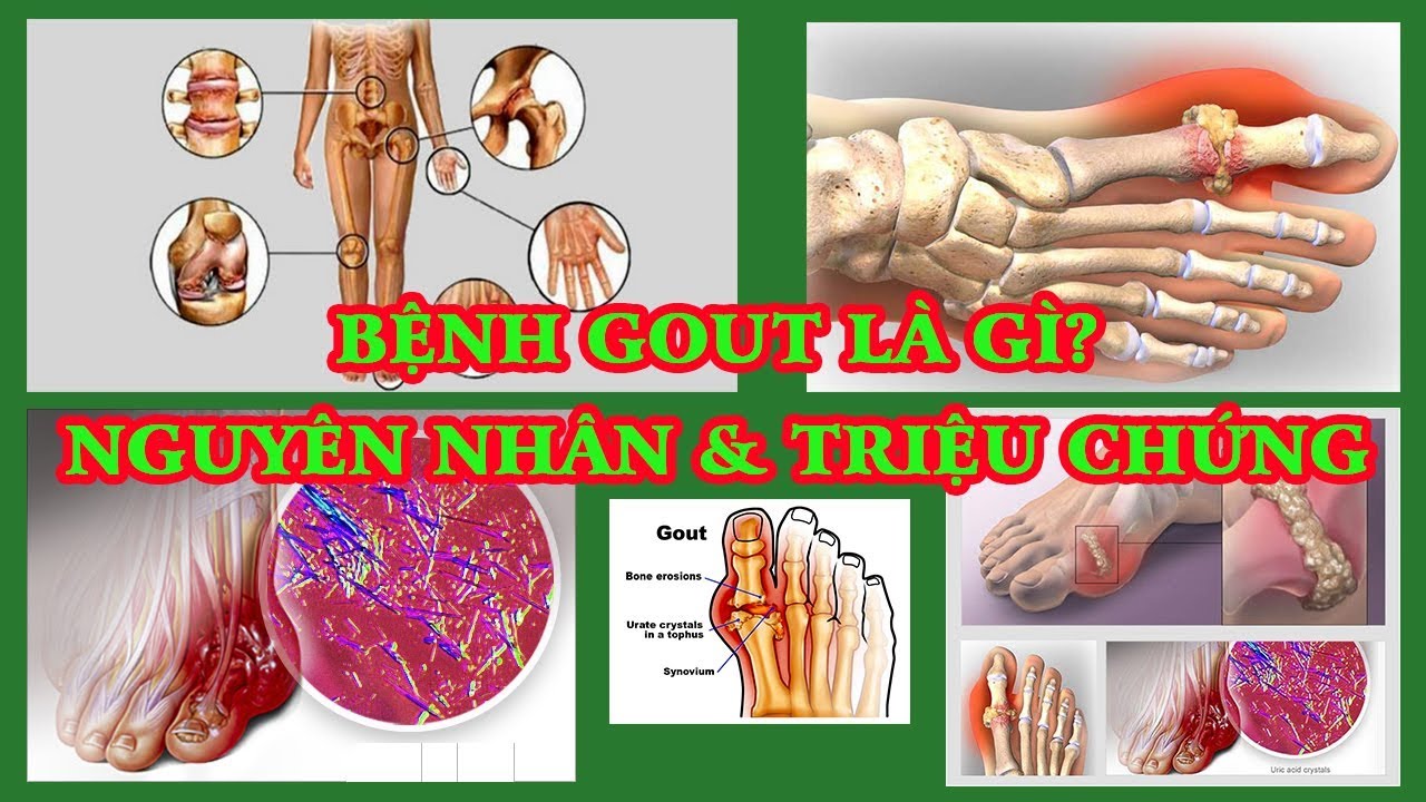 Bệnh gout là gì? Nguyên nhân và triệu chứng của bệnh gout