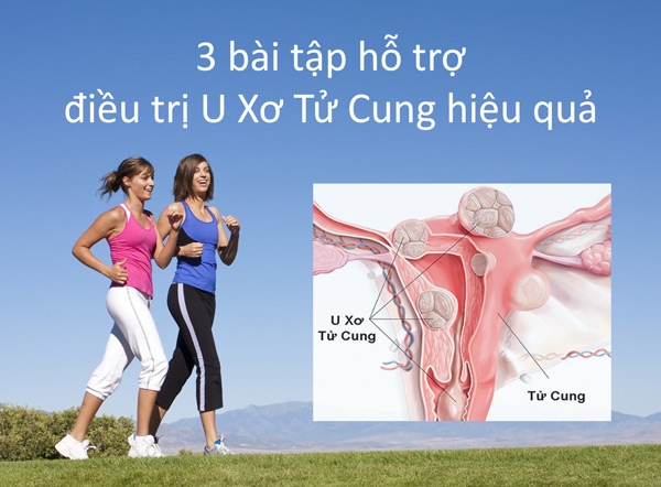 Bài tập hỗ trợ điều trị u xơ tử cung hiệu quả