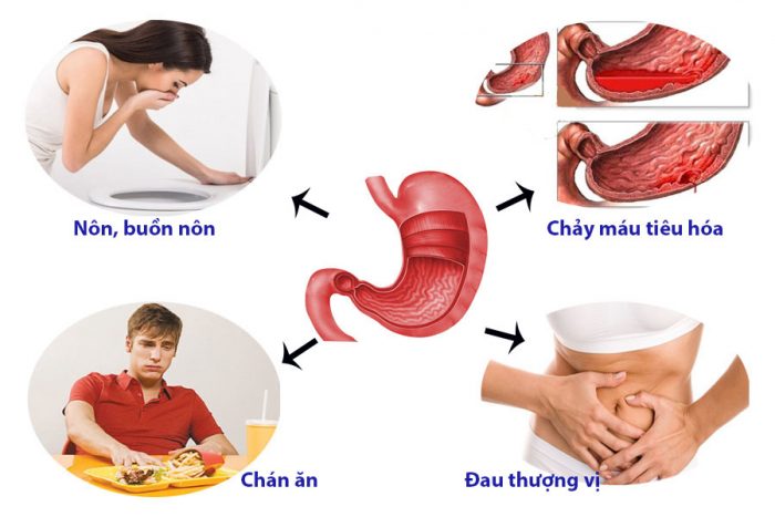 Cách chữa dứt điểm bệnh đau dạ dày?