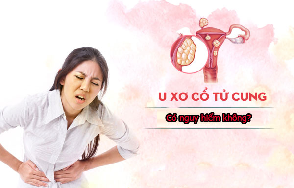 U xơ tử cung là gì, có nguy hiểm không?