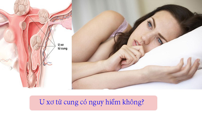 U xơ tử cung có nguy hiểm không?