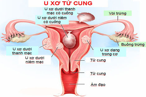 Bị u xơ tử cung nên uống thuốc gì?